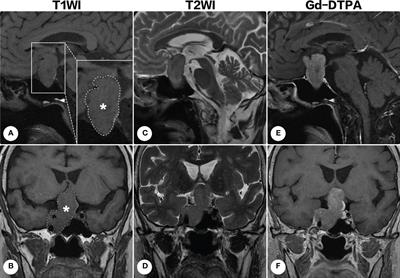 Case Report: Paraganglioma in the sellar region: longitudinal observation and surgical outcome